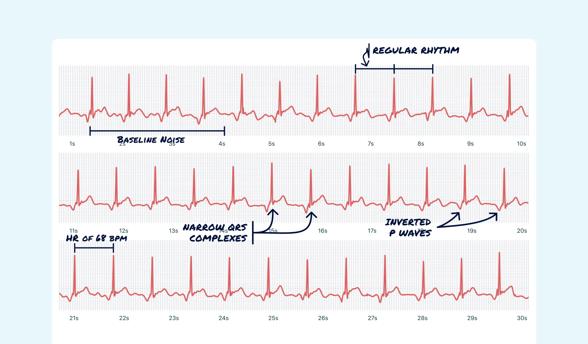 Junctional Rhythm Vs. First Degree AV Block on Your Watch ECG Qaly